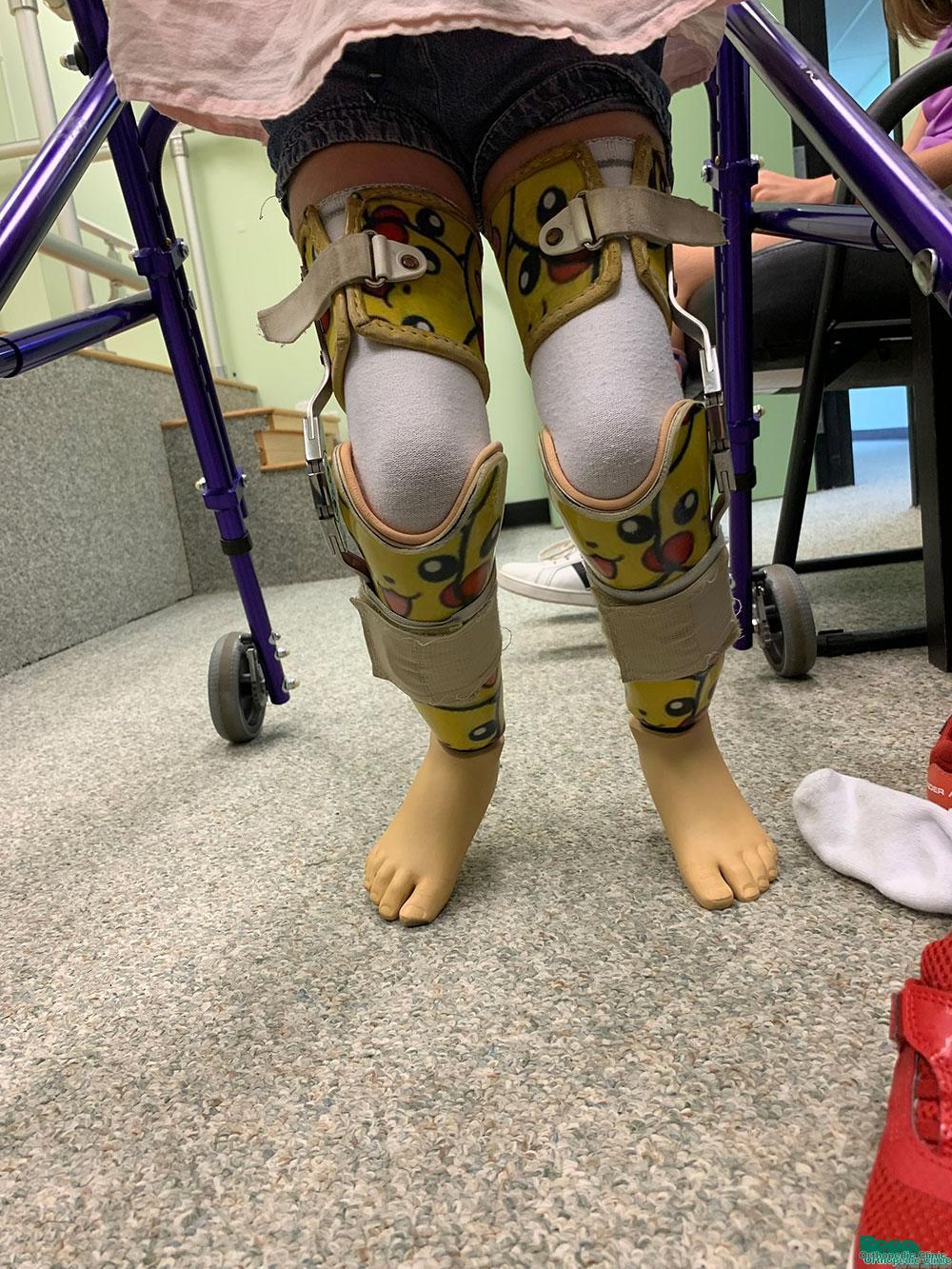A patient undergoing training and rehabilitation for an above-knee prosthesis.